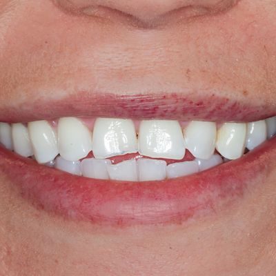 Composite Bonding - Smile 23 before